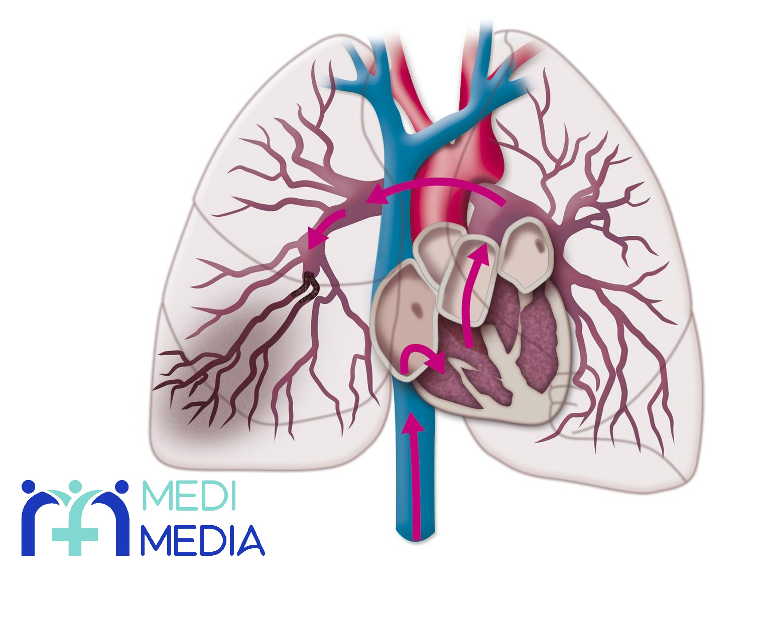آمبولی ریوی