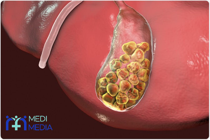 سنگ صفرا چیست؟